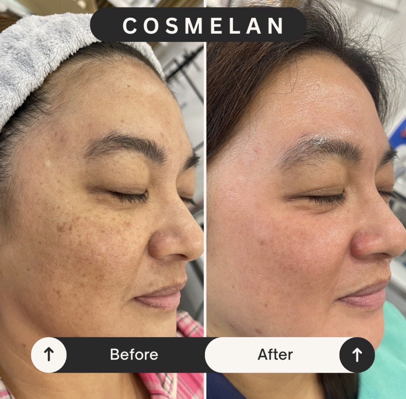 Before and after Cosmelan pigmentation treatment at VIP Cosmedics