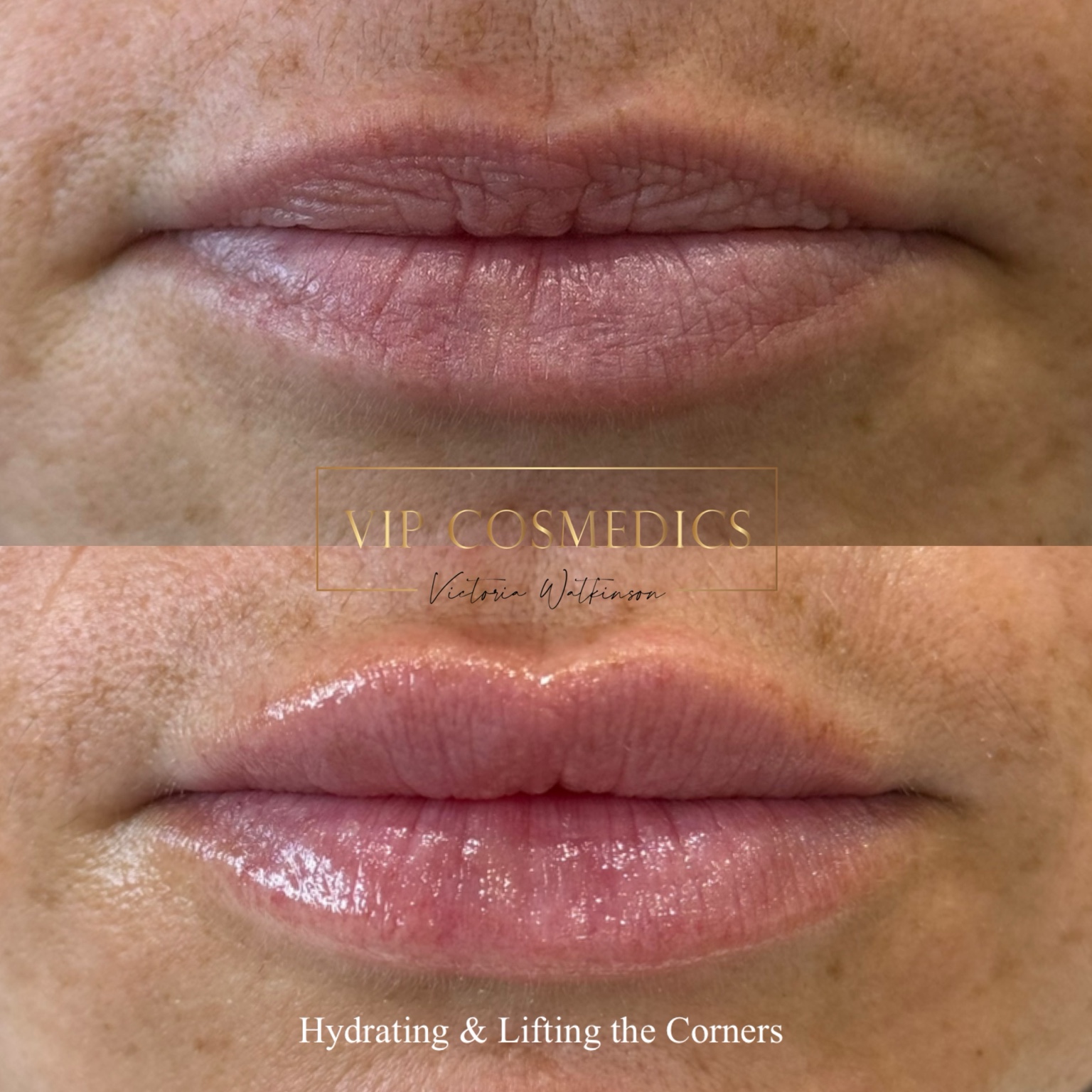 Before and after dermal lip filler for hydration and corner support