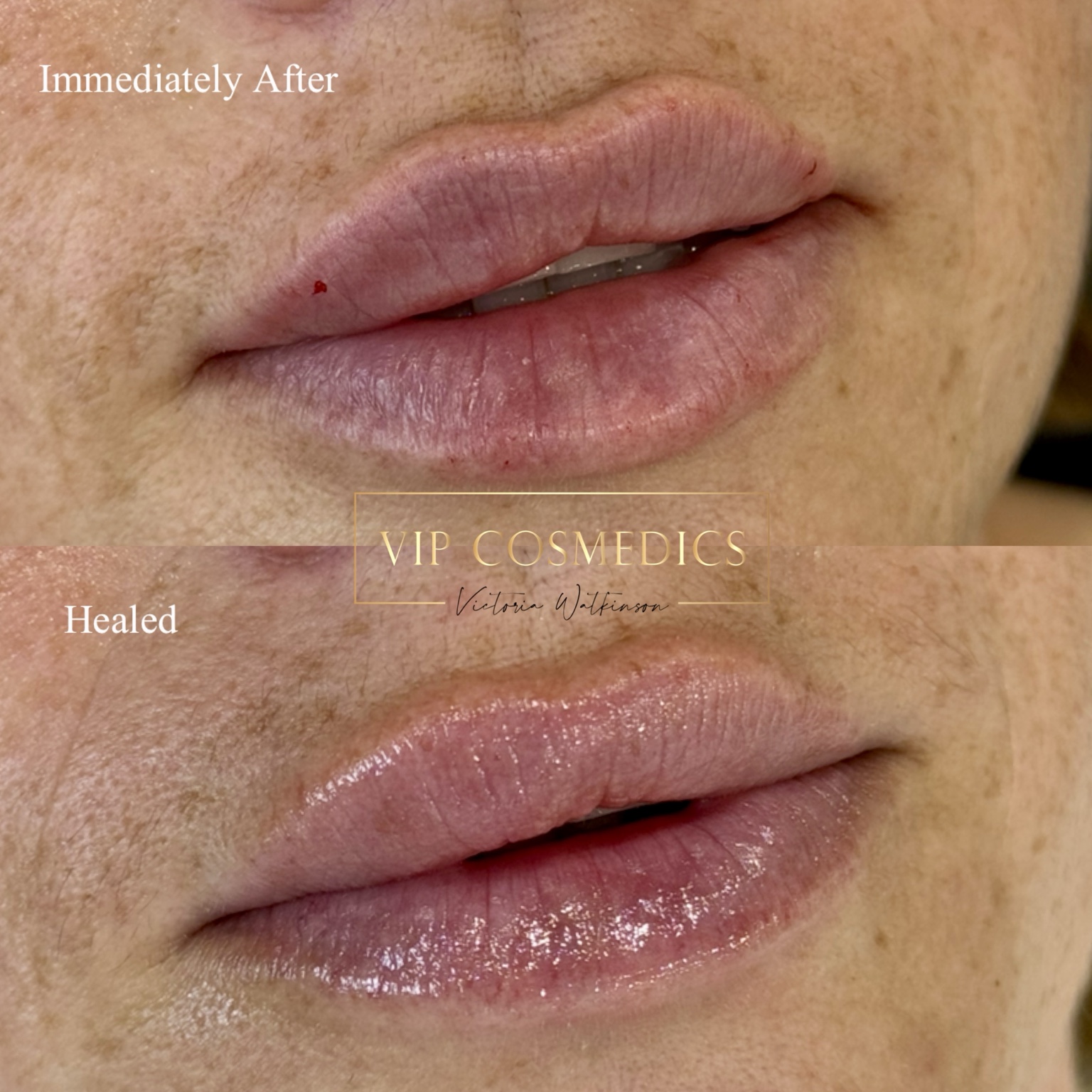 Immediate and healed dermal lip filler comparison