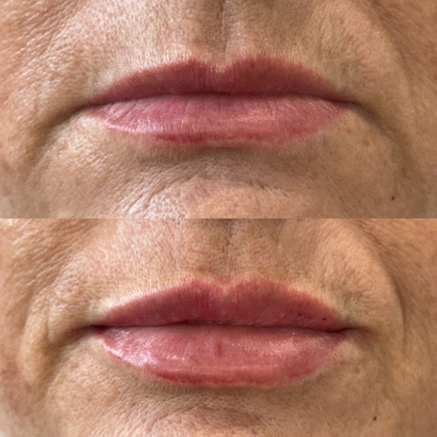 Before and after tailored dermal lip filler
