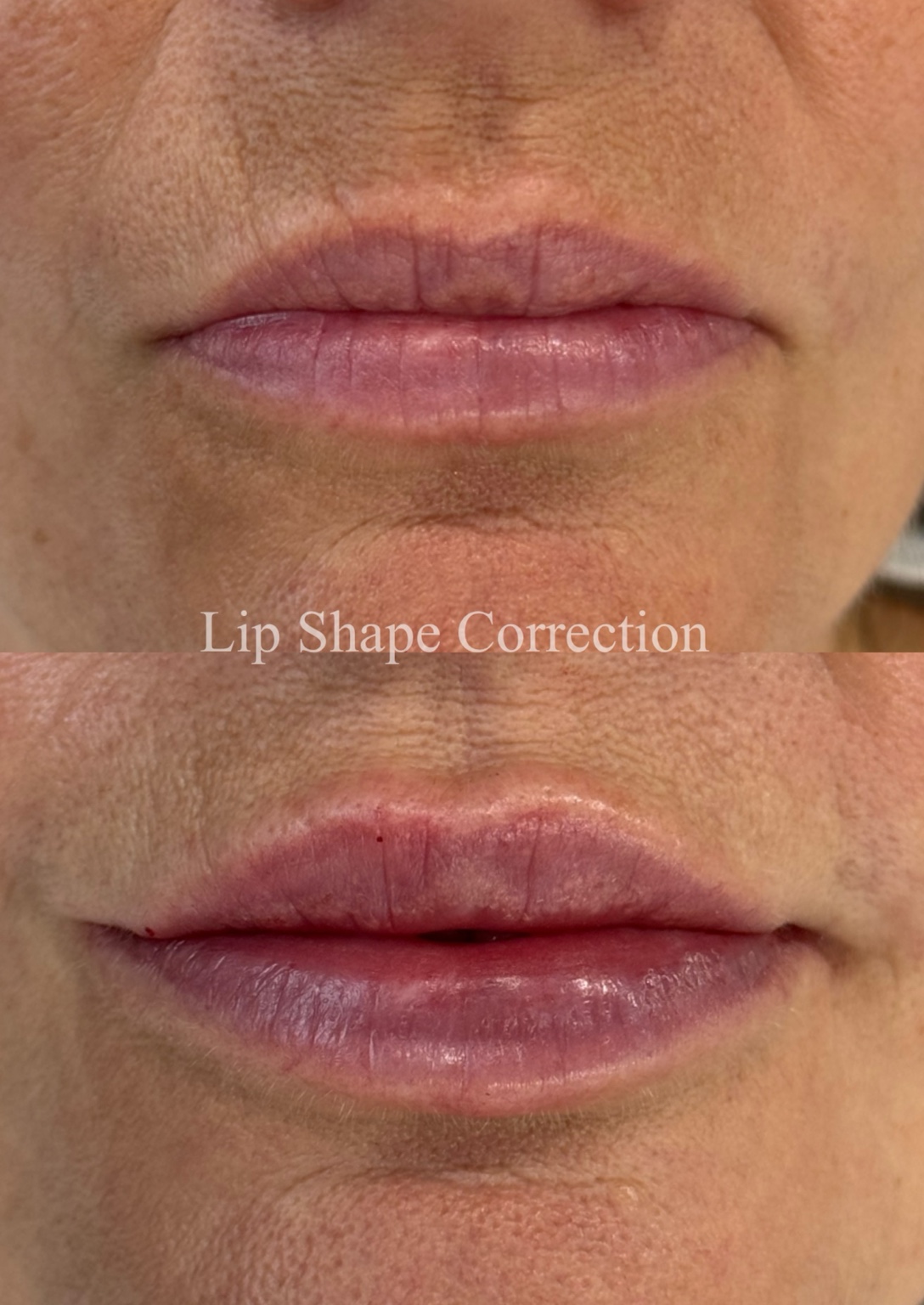 Before and after dermal filler lip shape correction