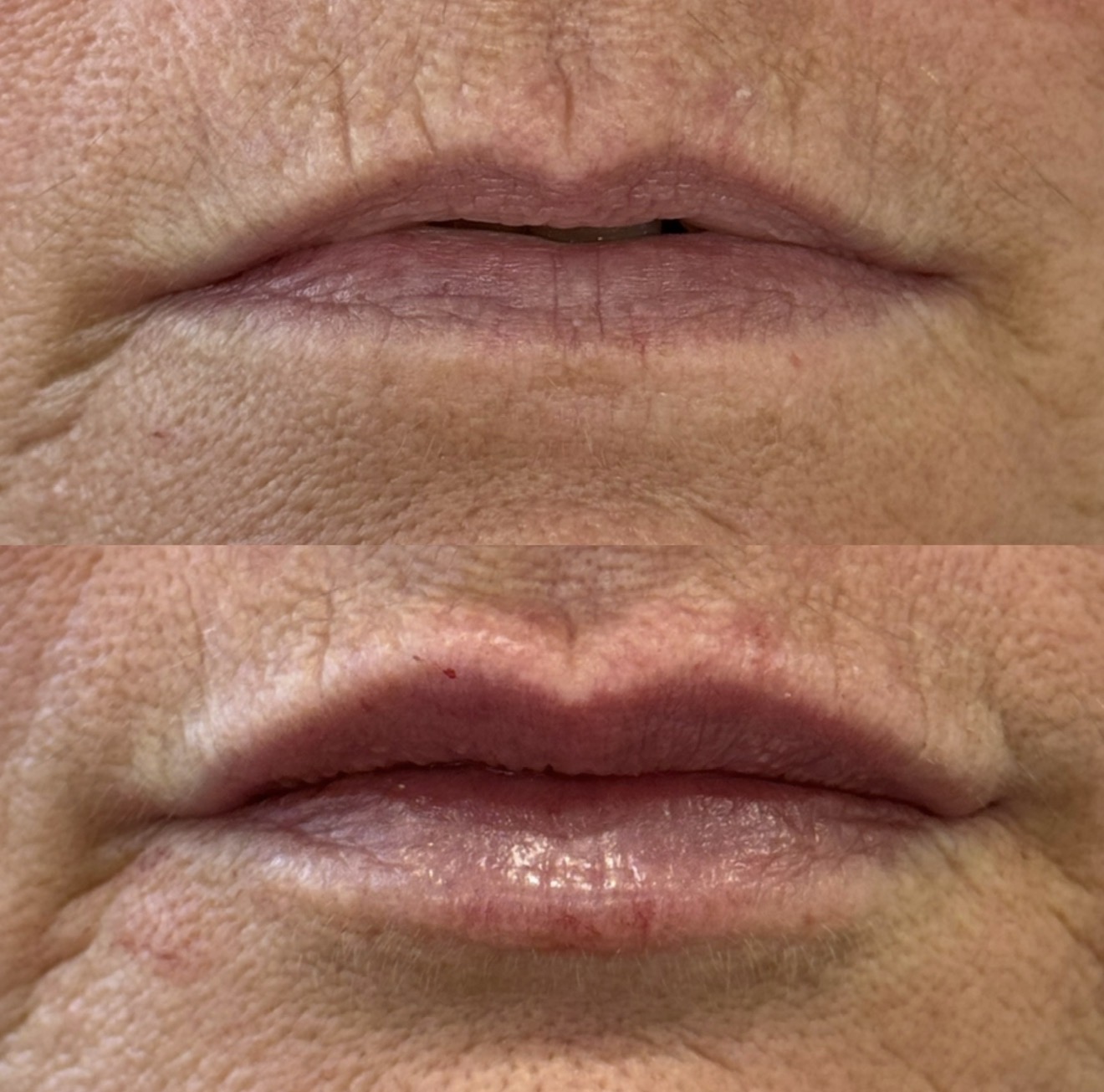 Before and after subtle dermal lip filler treatment