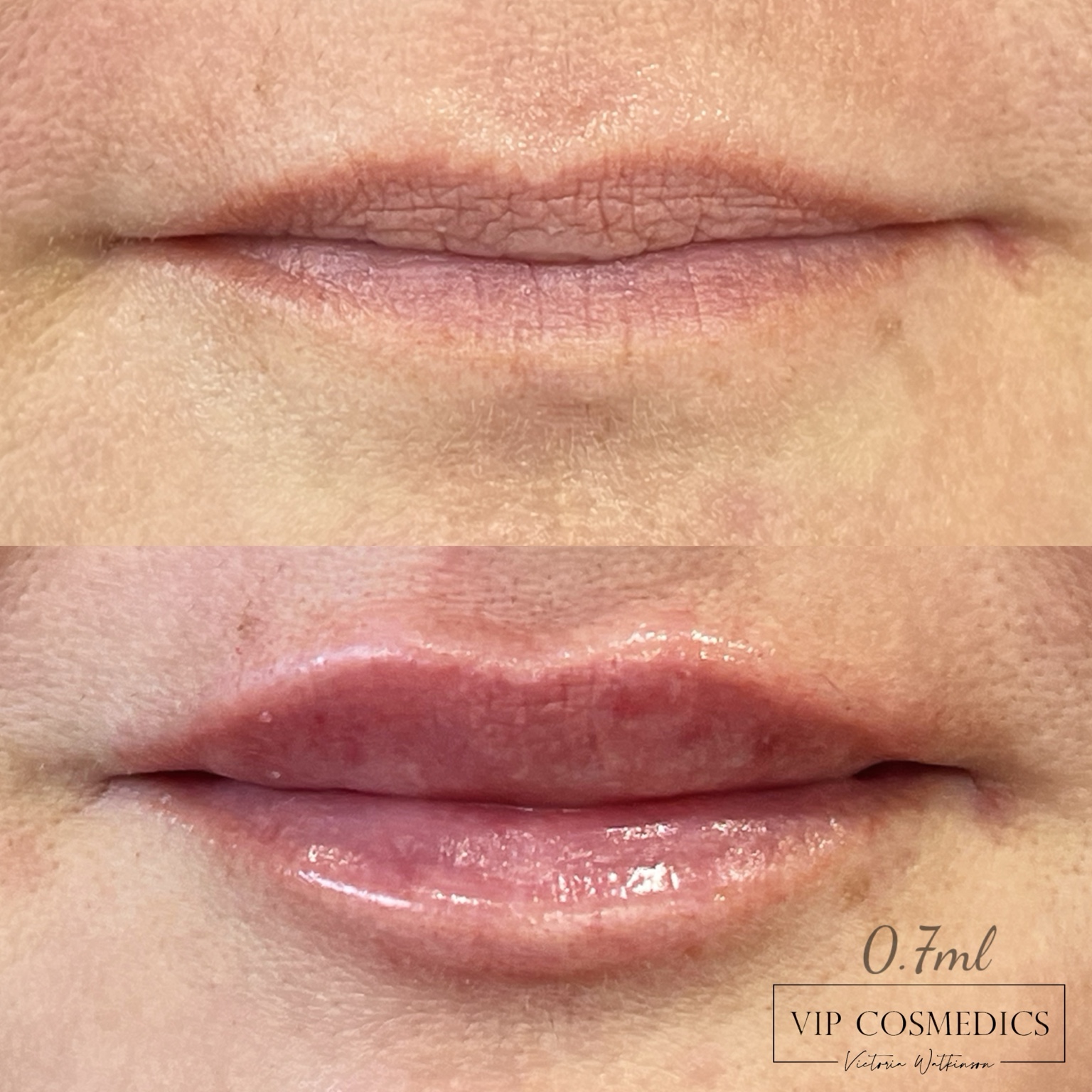Natural lip enhancement result at VIP Cosmedics