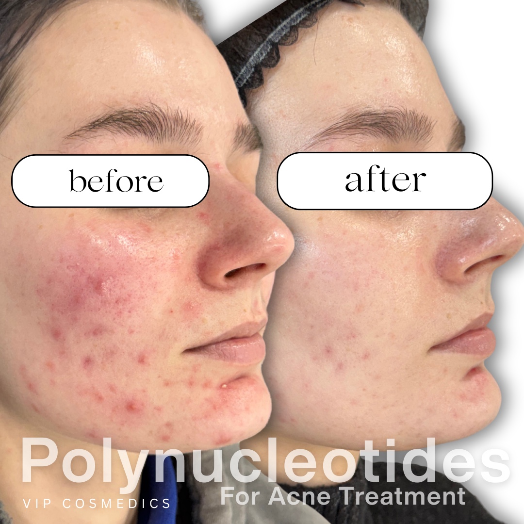 VIP Cosmedics client before and after polynucleotide treatment for acne