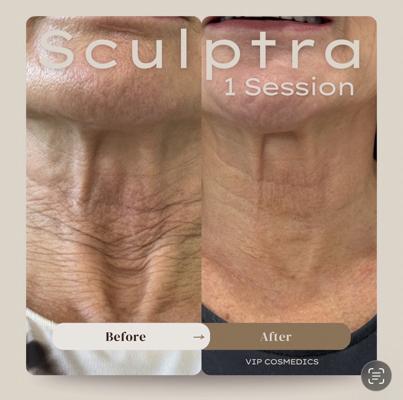 Front view before and after one Sculptra treatment to the neck