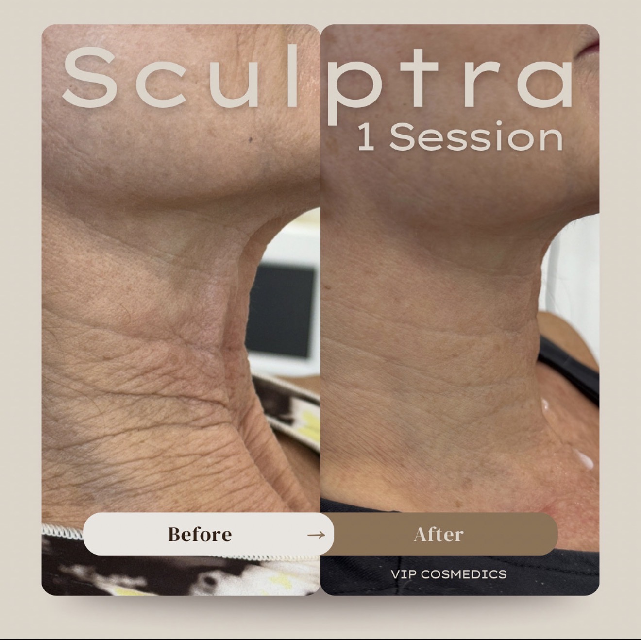 Side view before and after one Sculptra treatment to the neck
