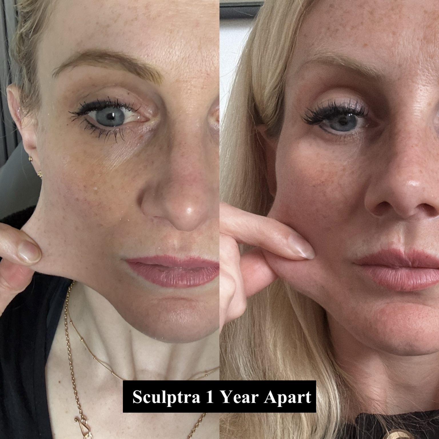 Victoria's personal Sculptra comparison photographed one year apart
